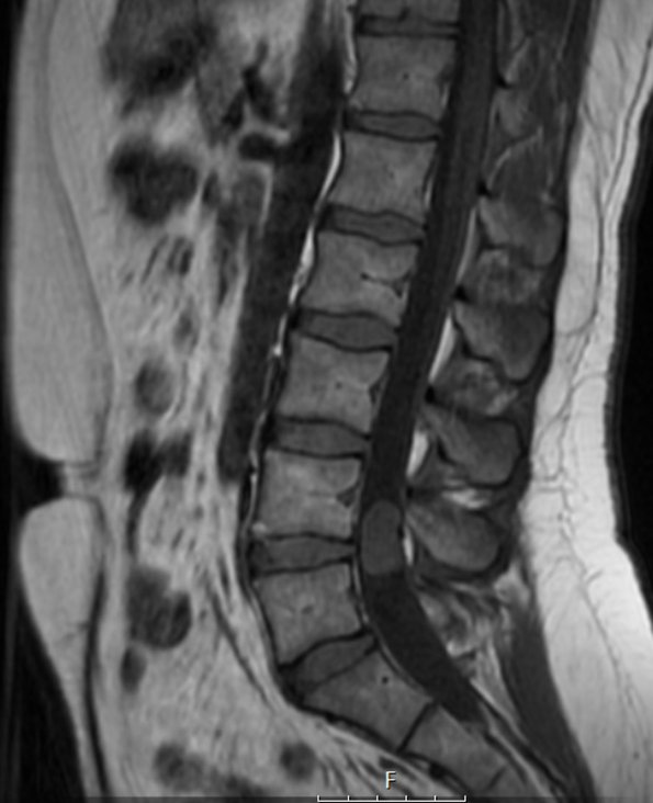 12A1 Paraganglioma (Case 12) T1 no C - Copy