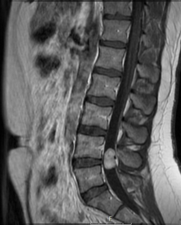 12A2 Paraganglioma (Case 12) T1 with C - Copy