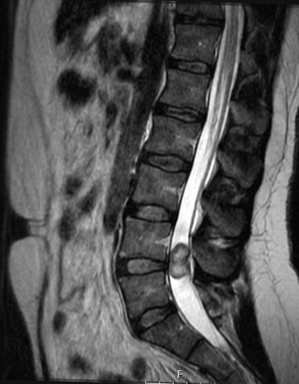 12A3 Paraganglioma (Case 12) T2 no - Copy