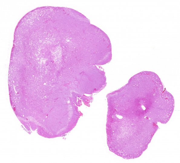 12B1 Paraganglioma (Case 12) H&E whole mount