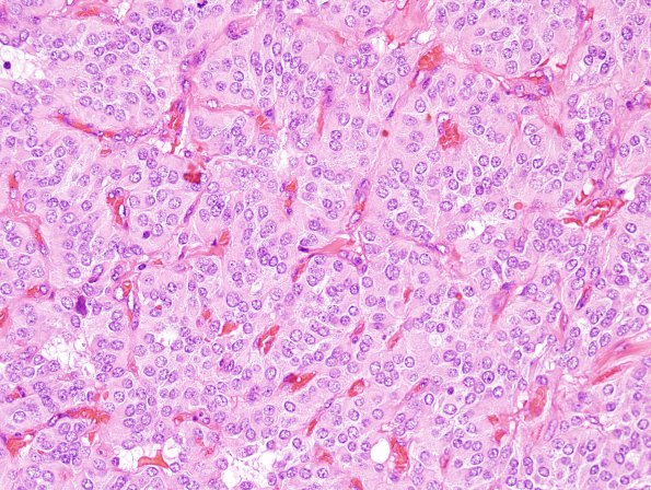 12B2 Paraganglioma (Case 12) H&E 2.jpg