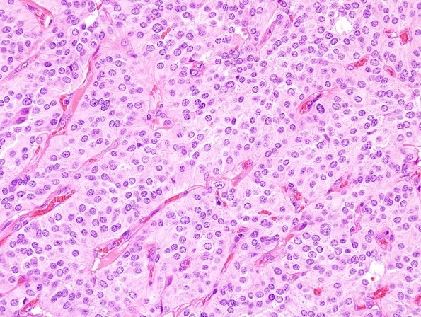 12B4 Paraganglioma (Case 12) H&E 7.jpg