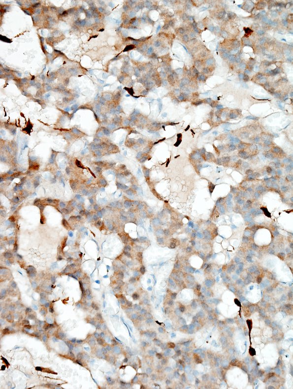 12D2 Paraganglioma (Case 12) S100 1.jpg