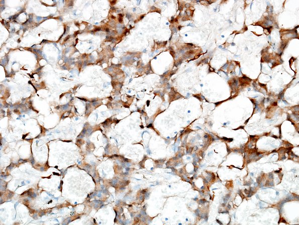 12D3 Paraganglioma (Case 12) S100 2.jpg