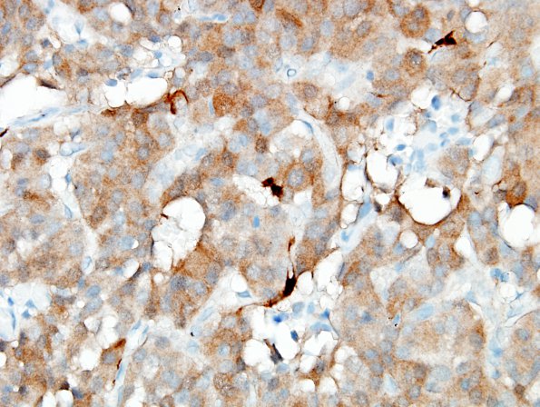 12D4 Paraganglioma (Case 12) S100 3.jpg