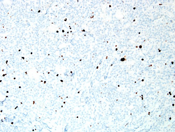 12E Paraganglioma (Case 12) Ki67 2.jpg