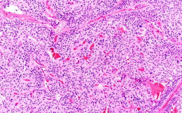 13A1 Paraganglioma (Case 13) H&E 20X