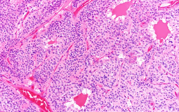 13A2 Paraganglioma (Case 13) H&E 20X 2
