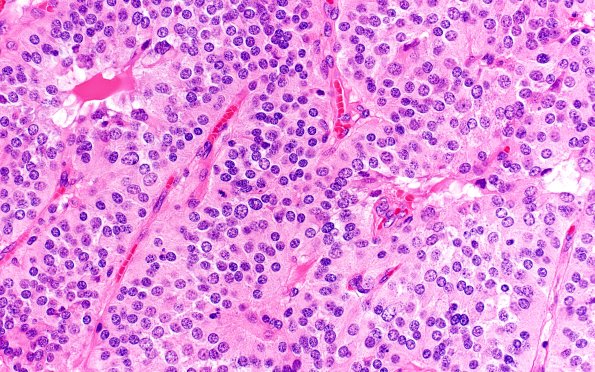 13A3 Paraganglioma (Case 13) H&E 40X 2