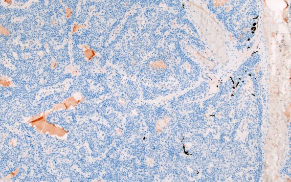 13C1 Paraganglioma (Case 13) S100 10X