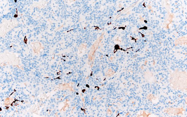 13C3 Paraganglioma (Case 13) S100 20X 2
