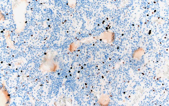 13D1 Paraganglioma (Case 13) Ki67 20X