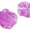 1B1 Paraganglioma, gangliocytic (Case 1) H&E WM