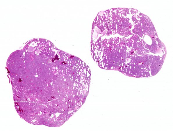 1B1 Paraganglioma, gangliocytic (Case 1) H&E WM