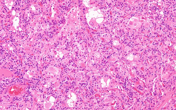 1B2 Paraganglioma, gangliocytic (Case 1) H&E 11