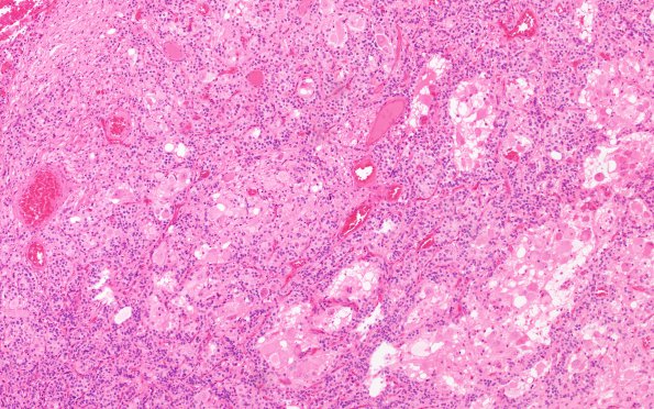 1B3 Paraganglioma, gangliocytic (Case 1) H&E 2