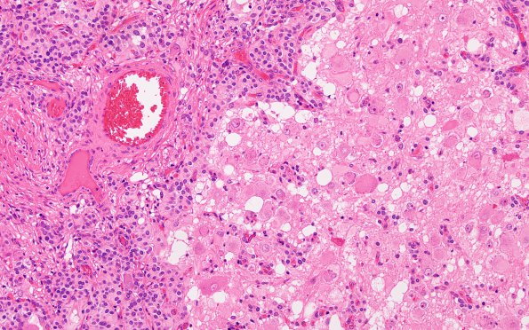 1B4 Paraganglioma, gangliocytic (Case 1) H&E 3