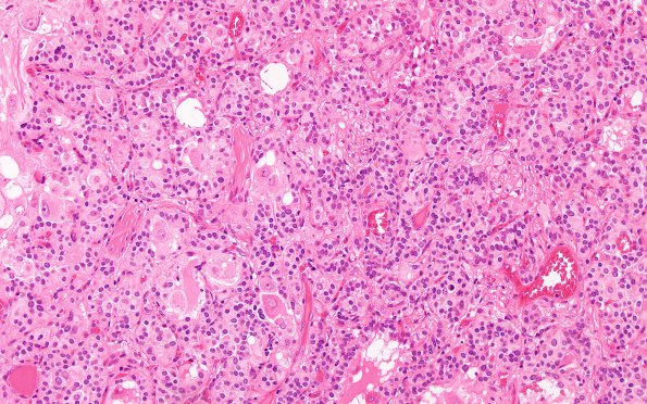 1B5 Paraganglioma, gangliocytic (Case 1) H&E 1