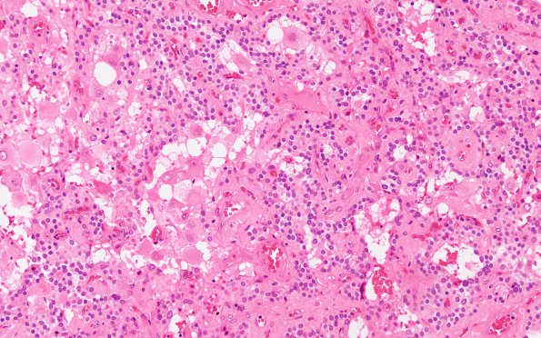 1B6 Paraganglioma, gangliocytic (Case 1) H&E 6