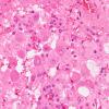 1B7 Paraganglioma, gangliocytic (Case 1) H&E 7