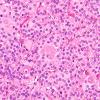 1B8 Paraganglioma, gangliocytic (Case 1) H&E 4