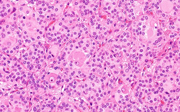 1B8 Paraganglioma, gangliocytic (Case 1) H&E 4