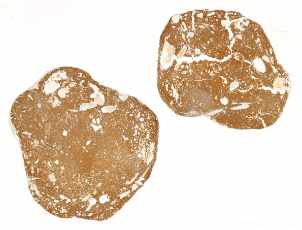 1C1 Paraganglioma, gangliocytic (Case 1) SYN WM