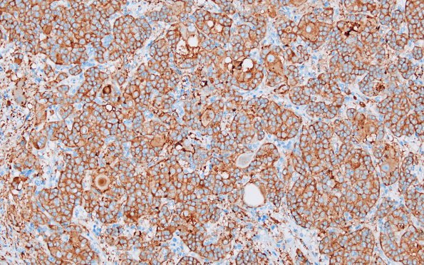 1C2 Paraganglioma, gangliocytic (Case 1) SYN 3