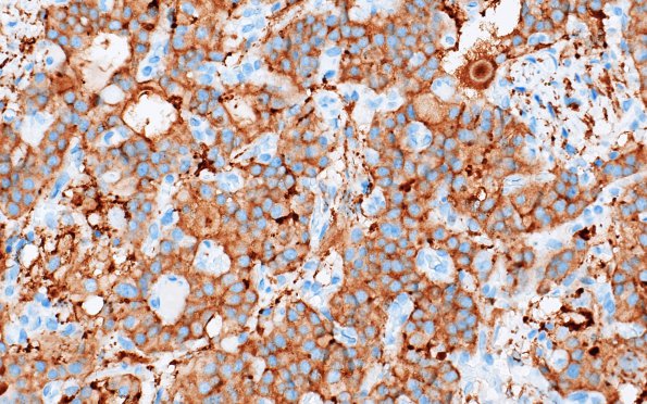 1C3 Paraganglioma, gangliocytic (Case 1) SYN 2