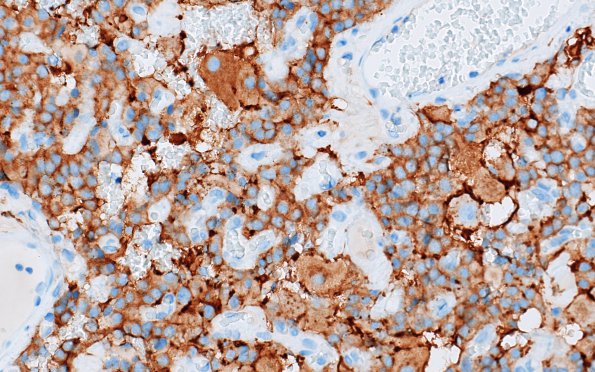 1C4 Paraganglioma, gangliocytic (Case 1) SYN 4