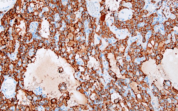 1C5 Paraganglioma, gangliocytic (Case 1) SYN 5