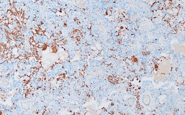 1D1 Paraganglioma, gangliocytic (Case 1) NF 3