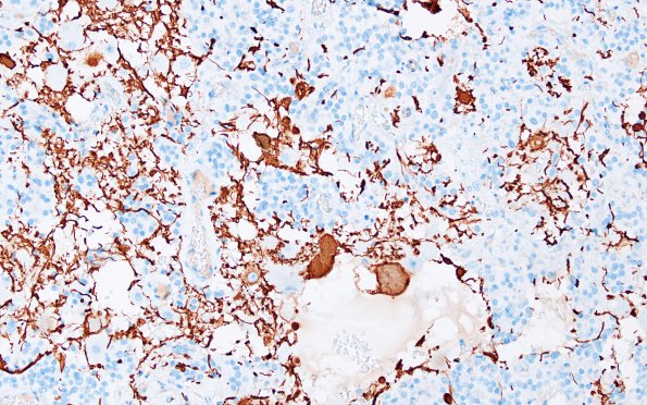 1D2 Paraganglioma, gangliocytic (Case 1) NF 2