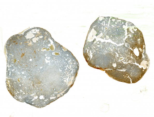 1E1 Paraganglioma, gangliocytic (Case 1) S100 WM