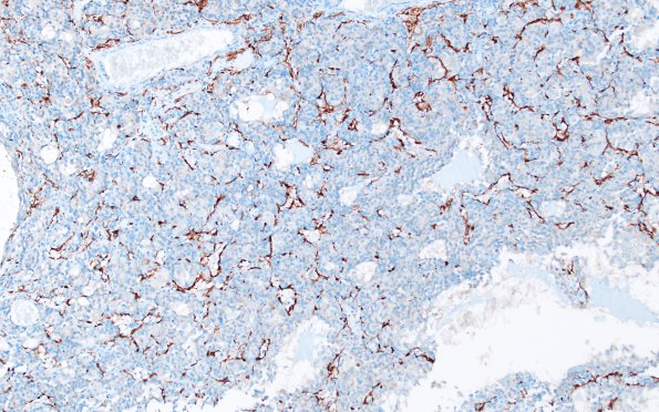 1E2 Paraganglioma, gangliocytic (Case 1) S100 6