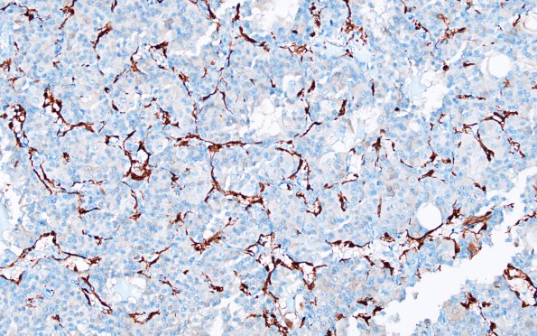 1E3 Paraganglioma, gangliocytic (Case 1) S100 4