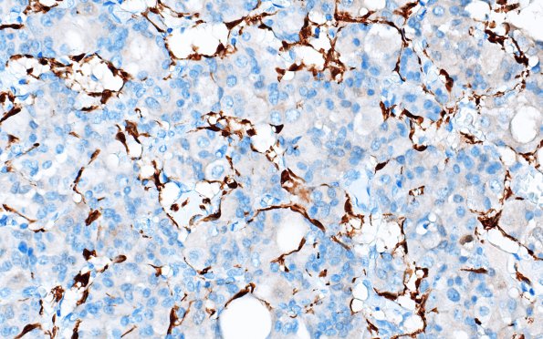 1E5 Paraganglioma, gangliocytic (Case 1) S100 2