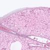 1F1 Paraganglioma, gangliocytic (Case 1) Retic 2X 2