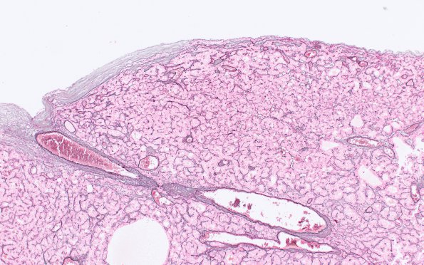 1F1 Paraganglioma, gangliocytic (Case 1) Retic 2X 2