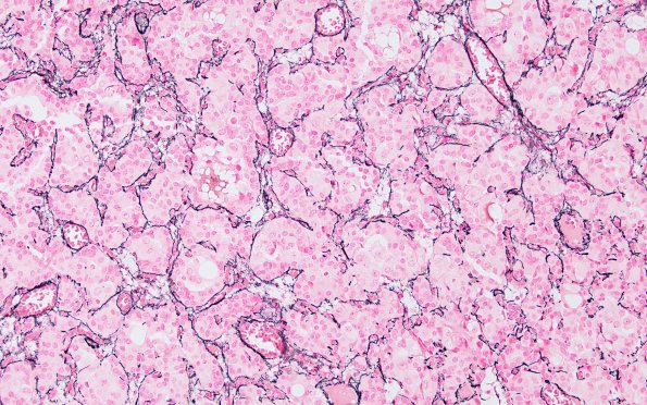 1F2 Paraganglioma, gangliocytic (Case 1) Retic 1