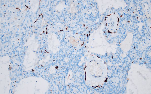 1G2 Paraganglioma, gangliocytic (Case 1) GFAP 20X