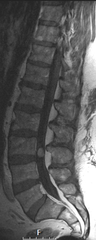 2A Paraganglioma (Case 2) T1 with Contras - Copy