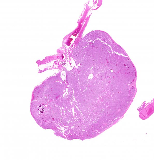 2B1 Paraganglioma (Case 2) H&E WM