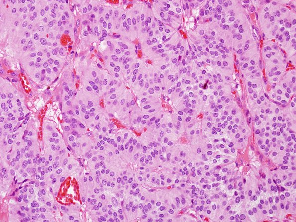 2B3 Paraganglioma (Case 2) H&E 5