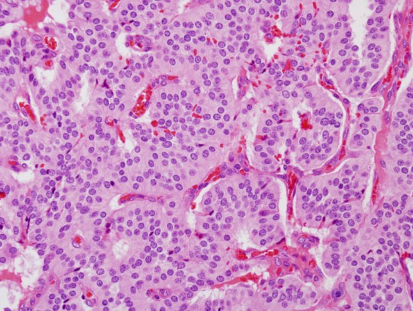 2B4 Paraganglioma (Case 2) H&E 2