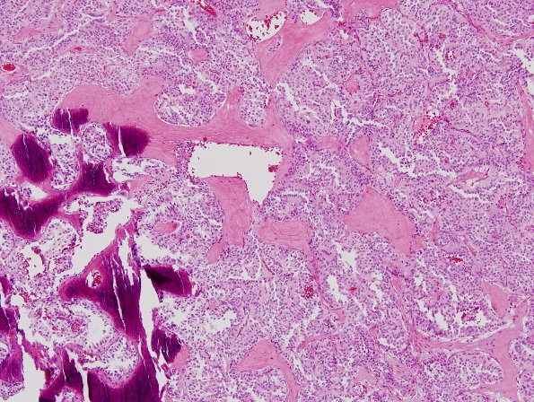 2B5 Paraganglioma (Case 2) H&E 3