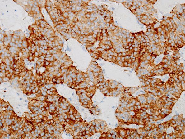 2C Paraganglioma (Case 2) SYN 1