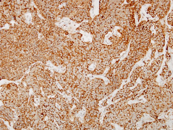 2D Paraganglioma (Case 2) Chromogranin 3