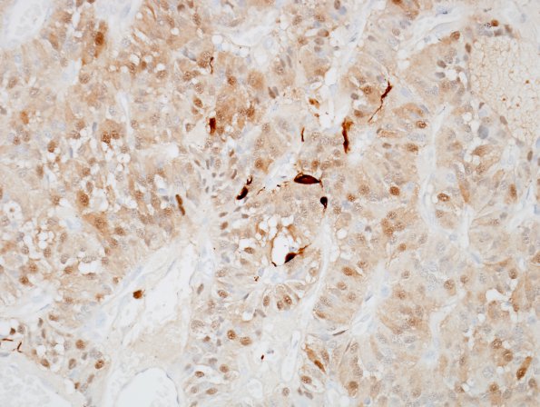 2E1 Paraganglioma (Case 2) S100 1