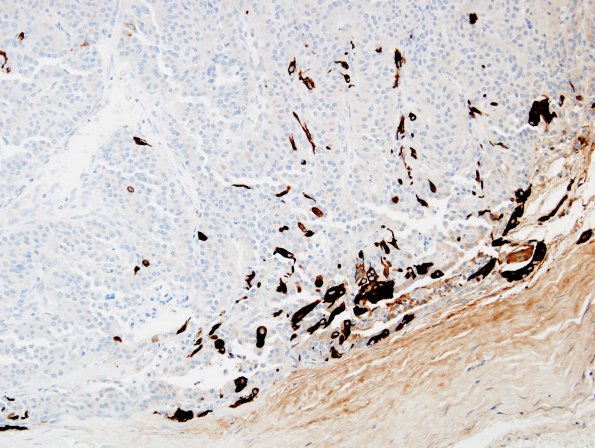 2F Paraganglioma (Case 2) GFAP 1